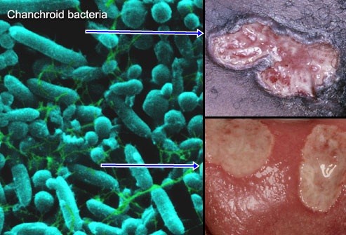 Jual Obat Sipilis De Nature Di Sinjai