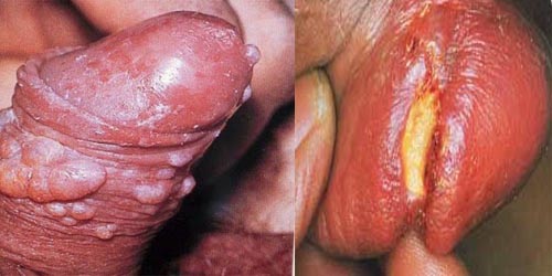 Jual Obat Sipilis De Nature Di Toli-Toli