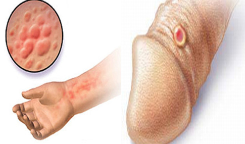 Jual Obat Sipilis De Nature Di Yahukimo