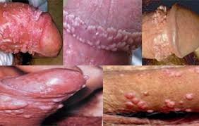 Jual Obat Sipilis De Nature Di Raja Ampat